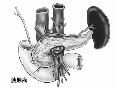 胰腺癌为何如此难治
