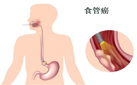 食道癌的症状及如何诊断