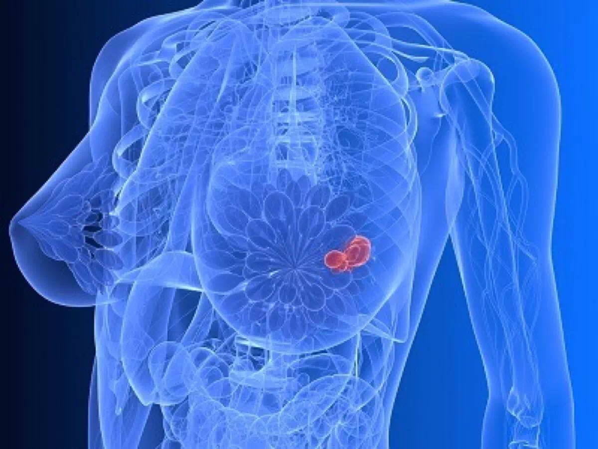 奥拉帕尼或能帮助有效抵御乳腺癌