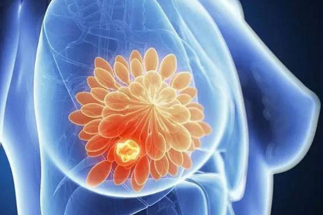 三阴性乳腺癌的免疫疗法